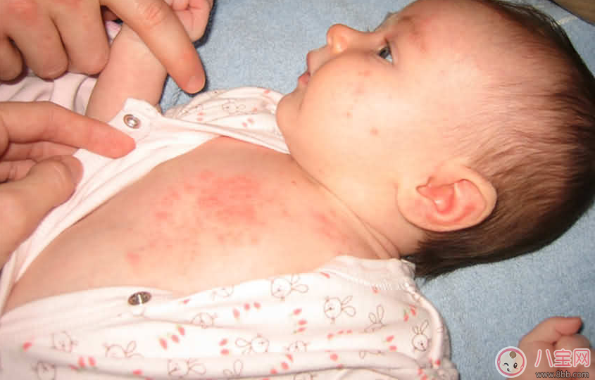 寶寶痱子總不消 用用這個準會好 寶寶痱子總不消 用用這個準會好