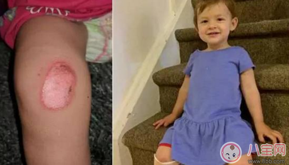 這樣居然也能燙傷 三伏天戶外兒童玩具少讓孩子玩