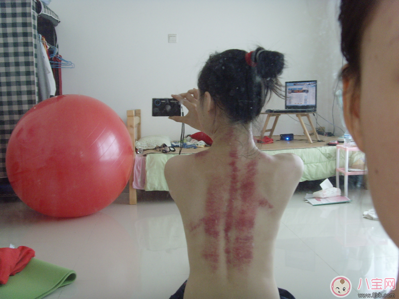 孕婦抓痧會流產嗎 中暑能抓痧嗎 孕婦抓痧會流產嗎 中暑能抓痧嗎