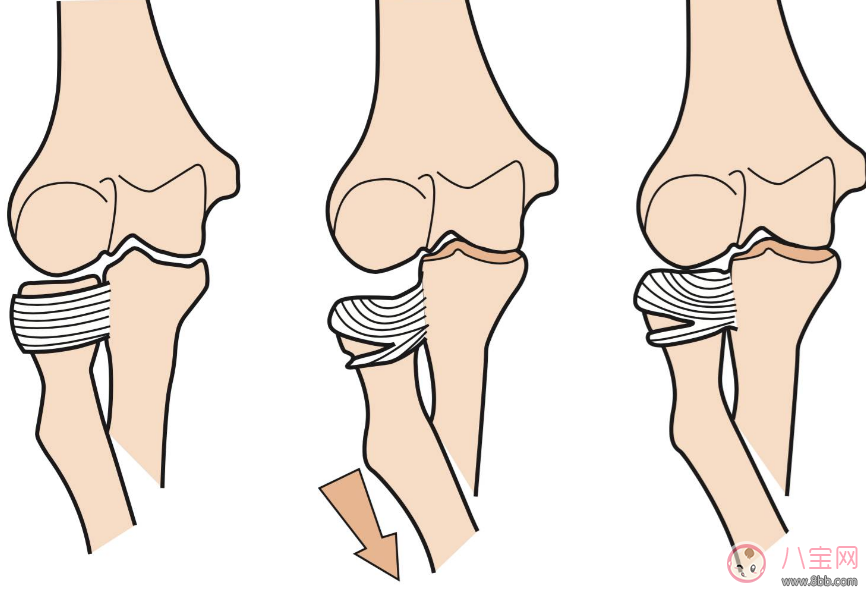 提孩子胳膊“蕩秋千”導致脫臼 孩子胳膊脫臼處理方法 提孩子胳膊“蕩秋千”導致脫臼 孩子胳膊脫臼處理方法
