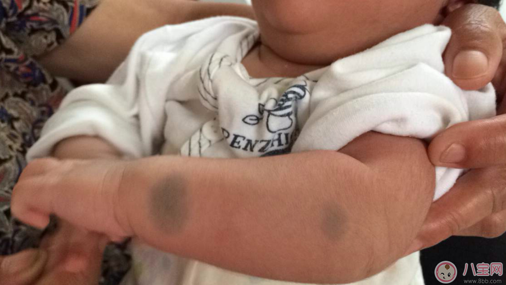 寶寶胎記會自己掉嗎 寶寶胎記去除方法 寶寶胎記會自己掉嗎 寶寶胎記去除方法