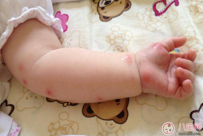 夏天寶寶招蚊子咬怎么辦 蚊子為什么總喜歡咬寶寶