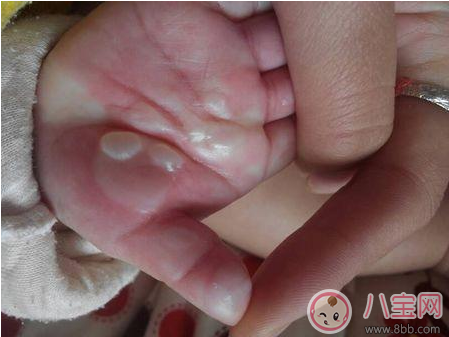 孩子燙傷后抹醬油有效嗎 這些偏方燙傷后千萬不要學 孩子燙傷后抹醬油有效嗎 這些偏方燙傷后千萬不要學