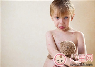 寶寶長水痘的原因 如何發現寶寶長水痘 寶寶長水痘的原因 如何發現寶寶長水痘