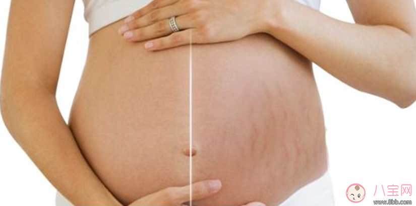 這些人居然天生不長妊娠紋 不長妊娠紋的奧秘是什么