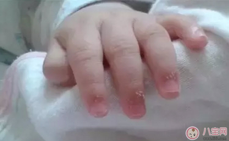 寶寶手上長肉刺是因為缺乏營養嗎 寶寶手指上長倒刺是什么原因