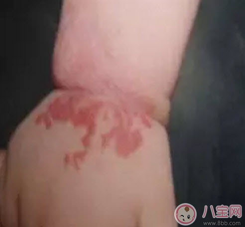 新生兒紅色胎記和血管瘤的對比方法 寶寶胎記和血管瘤的區別