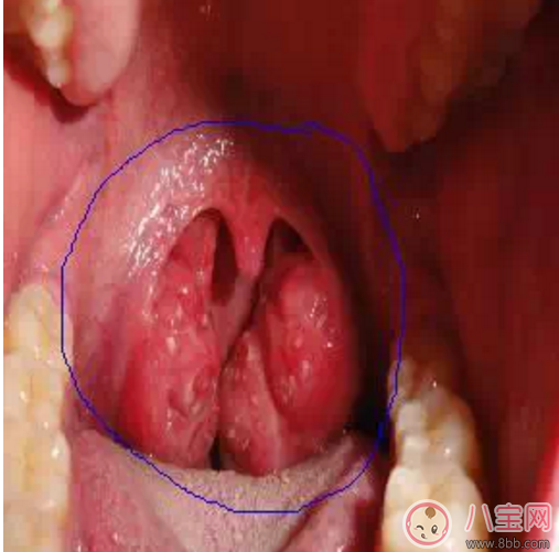 寶寶扁桃體炎表現 如何預防小兒扁桃體炎
