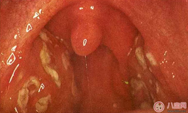 寶寶扁桃體炎表現 如何預防小兒扁桃體炎