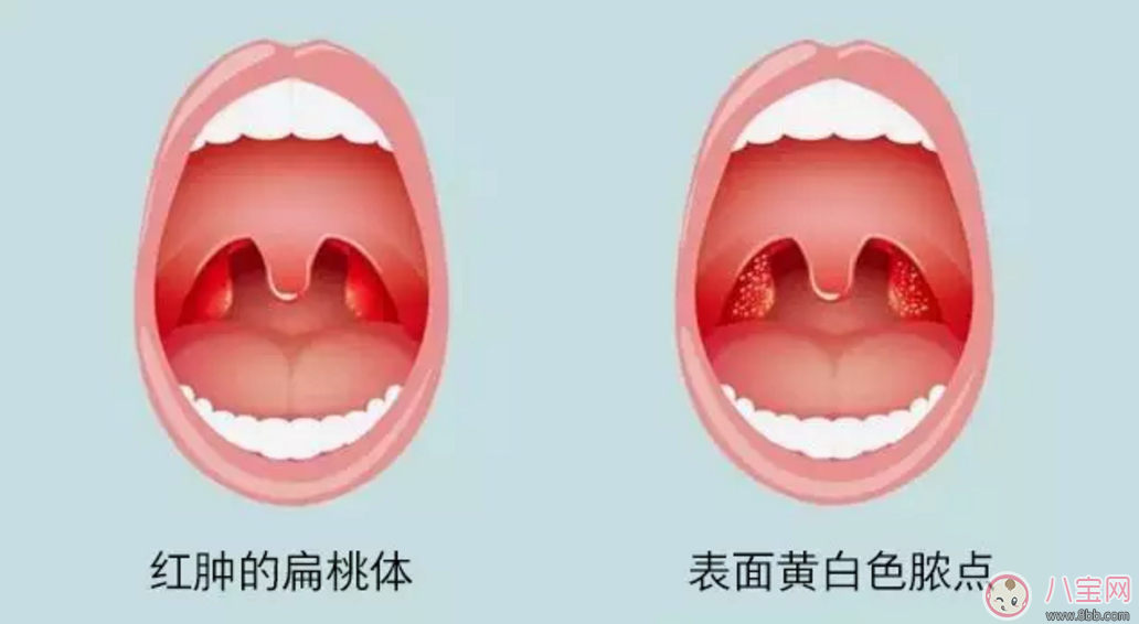 寶寶扁桃體炎表現 如何預防小兒扁桃體炎