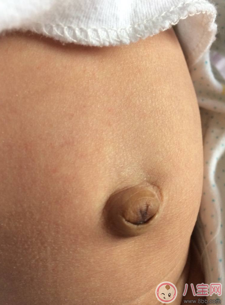 孩子肚子鼓的像個氣球 寶寶臍疝別忽視