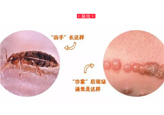 寶寶被臭蟲咬了癥狀圖片 寶寶被臭蟲咬和蚊子咬癥狀對比圖片區別