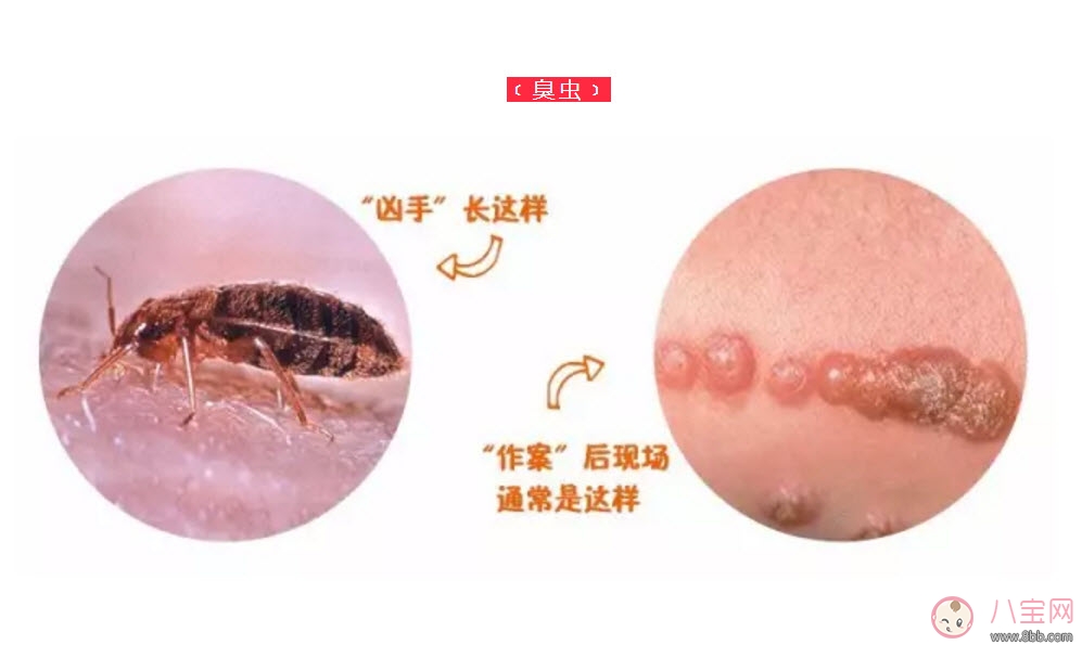 寶寶被臭蟲咬了癥狀圖片 寶寶被臭蟲咬和蚊子咬癥狀對比圖片區別