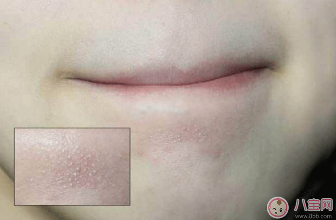 抿嘴時(shí)下巴上面的白色小顆粒是不是粉刺 抿嘴時(shí)下巴上面的白色小顆粒是不是粉刺
