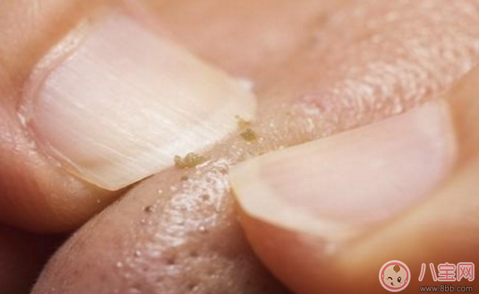 抿嘴時(shí)下巴上面的白色小顆粒是不是粉刺 抿嘴時(shí)下巴上面的白色小顆粒是不是粉刺