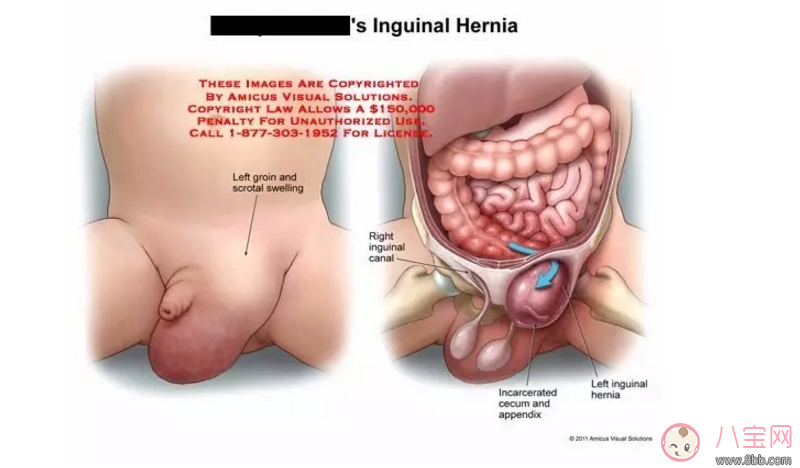 寶寶疝氣的癥狀 如何治療寶寶疝氣