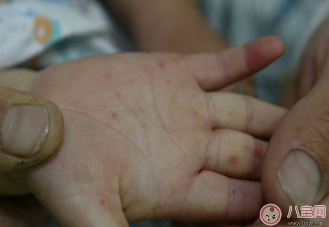 秋季怎么預防手足口病 2017兒童手足口病護理方法