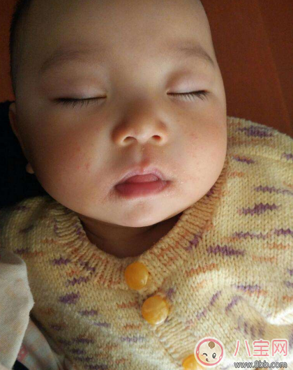 孩子太容易上火了怎么辦 孩子上火注意事項