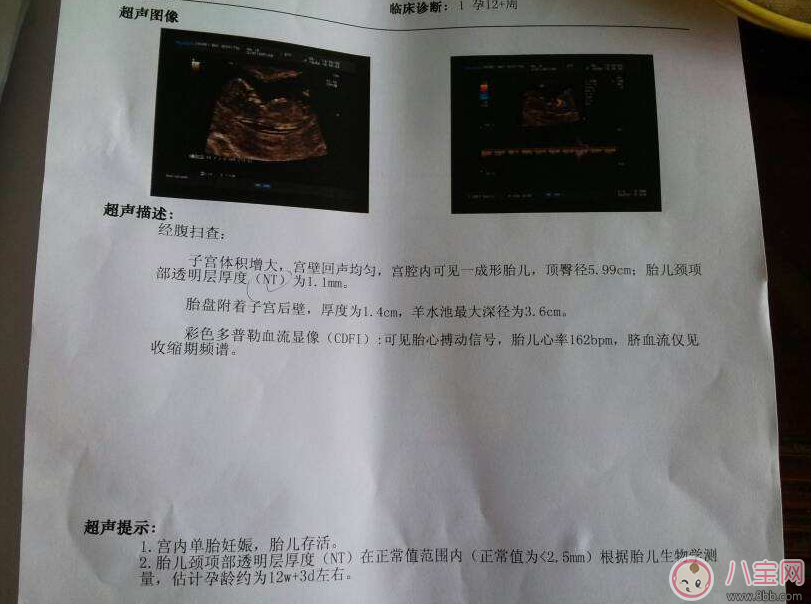 懷孕了有必要做NT檢查嗎 做NT檢查是什么體驗