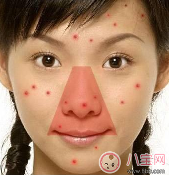 擠痘痘容易發生生命危險 怎么擠痘痘好 擠痘痘容易發生生命危險 怎么擠痘痘好