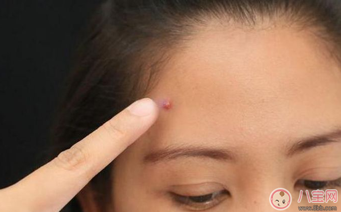 擠痘痘容易發生生命危險 怎么擠痘痘好 擠痘痘容易發生生命危險 怎么擠痘痘好