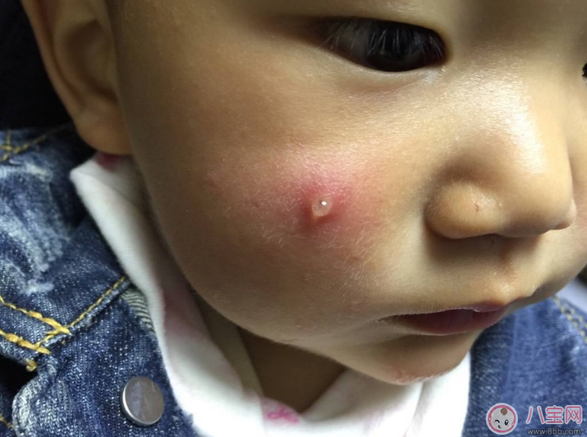 擠痘痘容易發生生命危險 怎么擠痘痘好 擠痘痘容易發生生命危險 怎么擠痘痘好