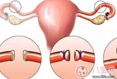 世界避孕日怎么正確避孕 除了毓婷還有哪些方法可以避孕