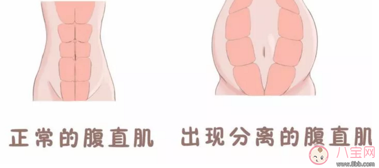 腹直肌分離自測方法 腹直肌分離的危害有哪些