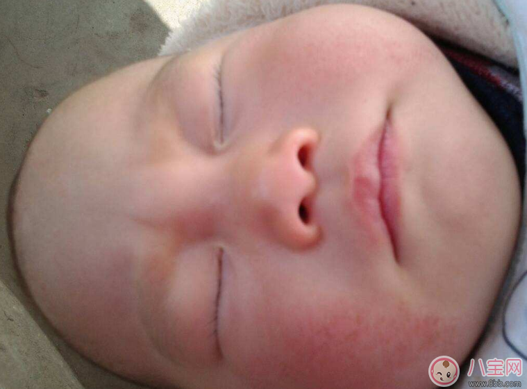 孩子身上長牛皮癬怎么辦 怎么正確護(hù)理孩子的皮膚