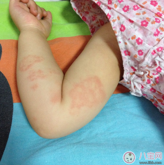 孩子身上長牛皮癬怎么辦 怎么正確護(hù)理孩子的皮膚