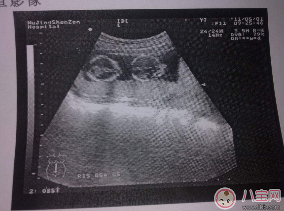 孕檢B超要問醫(yī)生哪些問題 孕檢B超后必問的醫(yī)生的問題