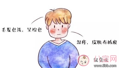 苯丙酮尿癥（PKU）是什么遺傳病 苯丙酮尿癥的臨床表現是什么能治療嗎