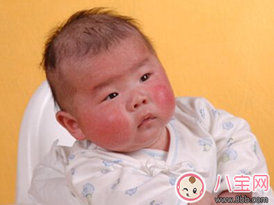 打疫苗引發川崎病是真的嗎 孩子患川崎病有哪些癥狀