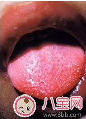 打疫苗引發川崎病是真的嗎 孩子患川崎病有哪些癥狀