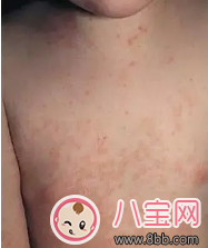 打疫苗引發川崎病是真的嗎 孩子患川崎病有哪些癥狀