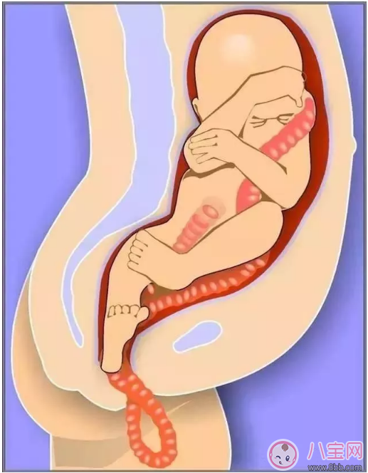 臍帶脫垂的緊急處理辦法是什么 如何預防臍帶脫垂 臍帶脫垂的緊急處理辦法是什么 如何預防臍帶脫垂