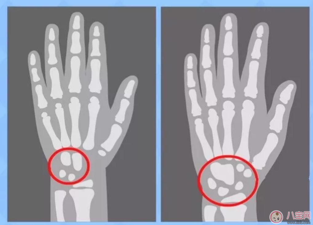 孩子性早熟會長不高嗎 孩子性早熟會引發哪些疾病