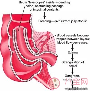 腸道疊的三大典型癥狀是什么 腸道疊是怎么引起的怎么治療預防 腸道疊的三大典型癥狀是什么 腸道疊是怎么引起的怎么治療預防