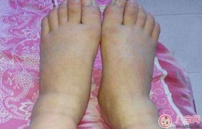 懷孕后期孕婦水腫怎么辦 懷孕后期孕婦水腫解決方法