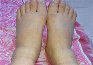 懷孕后期孕婦水腫怎么辦 懷孕后期孕婦水腫解決方法