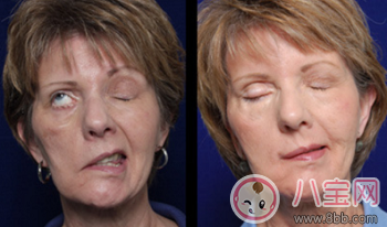 秋冬季被風吹襲受涼致面癱 面癱究竟是什么病面癱了怎么辦面癱了怎么辦 秋冬季被風吹襲受涼致面癱 面癱究竟是什么病面癱了怎么辦面癱了怎么辦