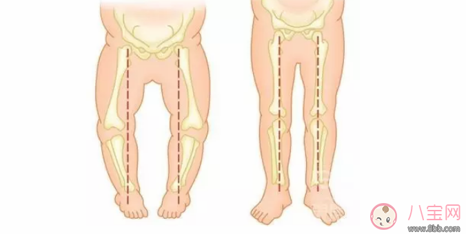 穿紙尿褲會讓孩子O型腿嗎 如何預防寶寶O型腿