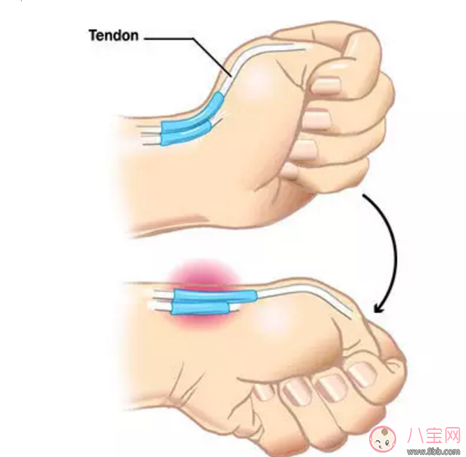 孕婦腱鞘炎怎么引起的 孕婦手腕手指腱鞘炎怎么辦