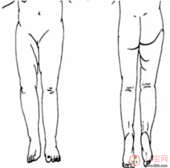 寶寶腿紋不對稱一定有問題嗎 寶寶腿紋不對稱檢查圖 寶寶腿紋不對稱一定有問題嗎 寶寶腿紋不對稱檢查圖