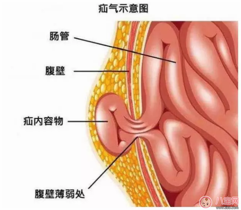 大腿內(nèi)側(cè)腫了個包是疝氣嗎 如何發(fā)現(xiàn)寶寶疝氣 大腿內(nèi)側(cè)腫了個包是疝氣嗎 如何發(fā)現(xiàn)寶寶疝氣