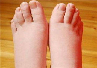 孕婦病理性水腫什么癥狀 孕期病理性水腫會高血壓嗎