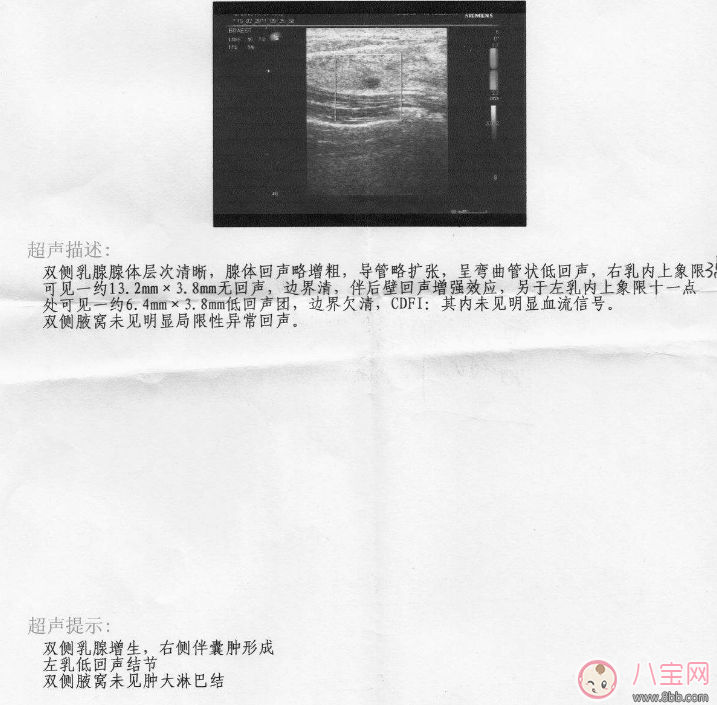 B超報告單乳腺增生小葉增生是什么意思 婦科B超單乳腺增生有影響嗎
