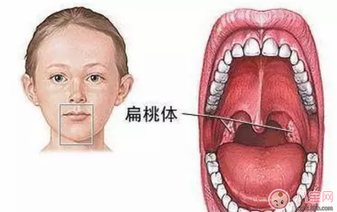 寶寶扁桃體發炎發燒不止怎么辦 扁桃體到底該不該切