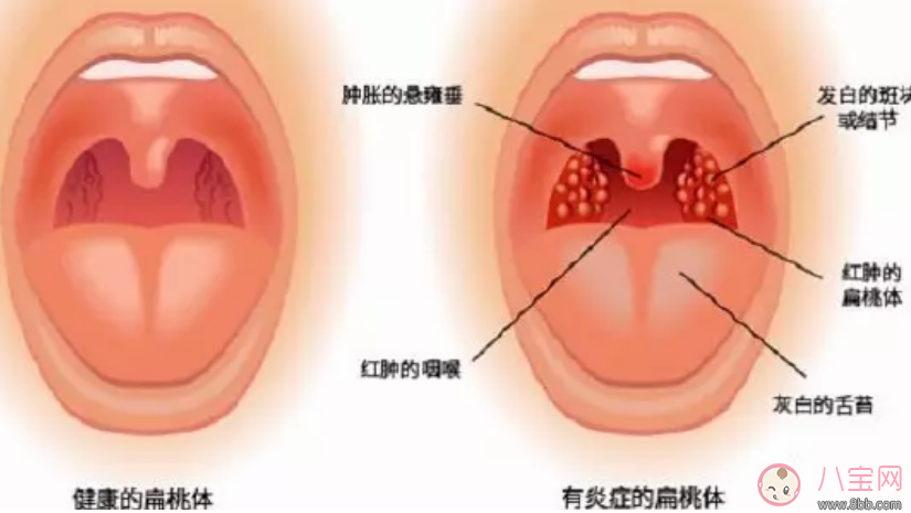 為什么寶寶的扁桃體不要輕易切除 如何預防寶寶扁桃體發炎