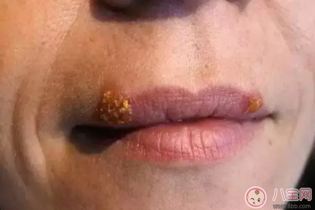 EB病毒是什么 兒童感染EB病毒嚴重嗎 EB病毒是什么 兒童感染EB病毒嚴重嗎